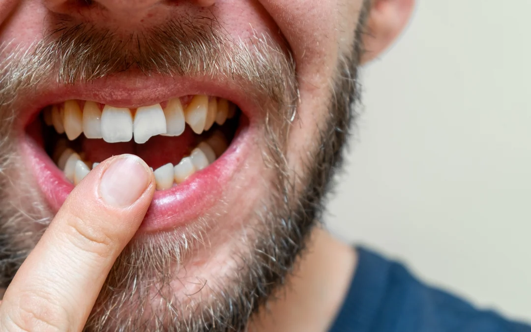 Dental Injuries After A Car Accident: Symptoms You Should Never Ignore